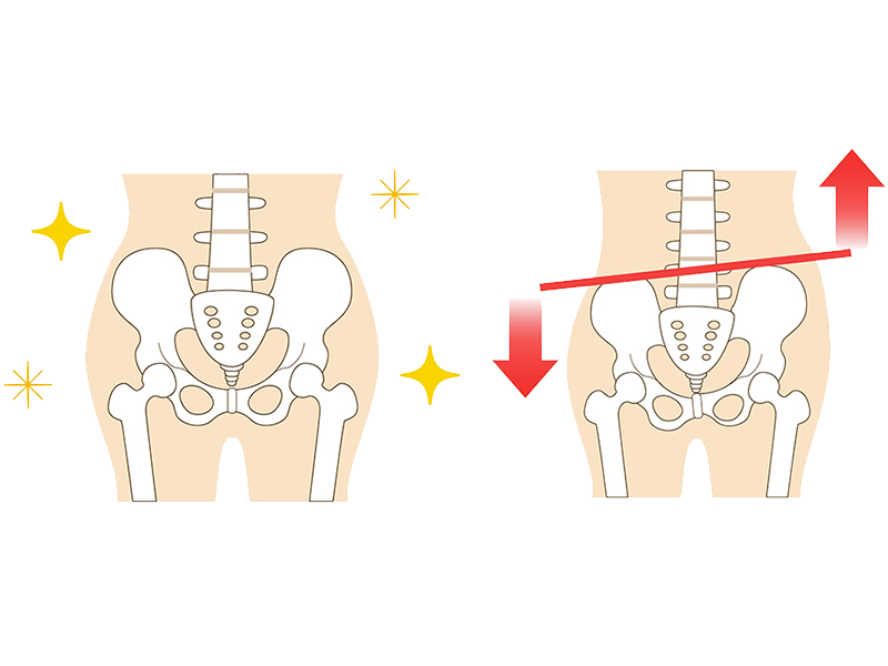 骨盤矯正について